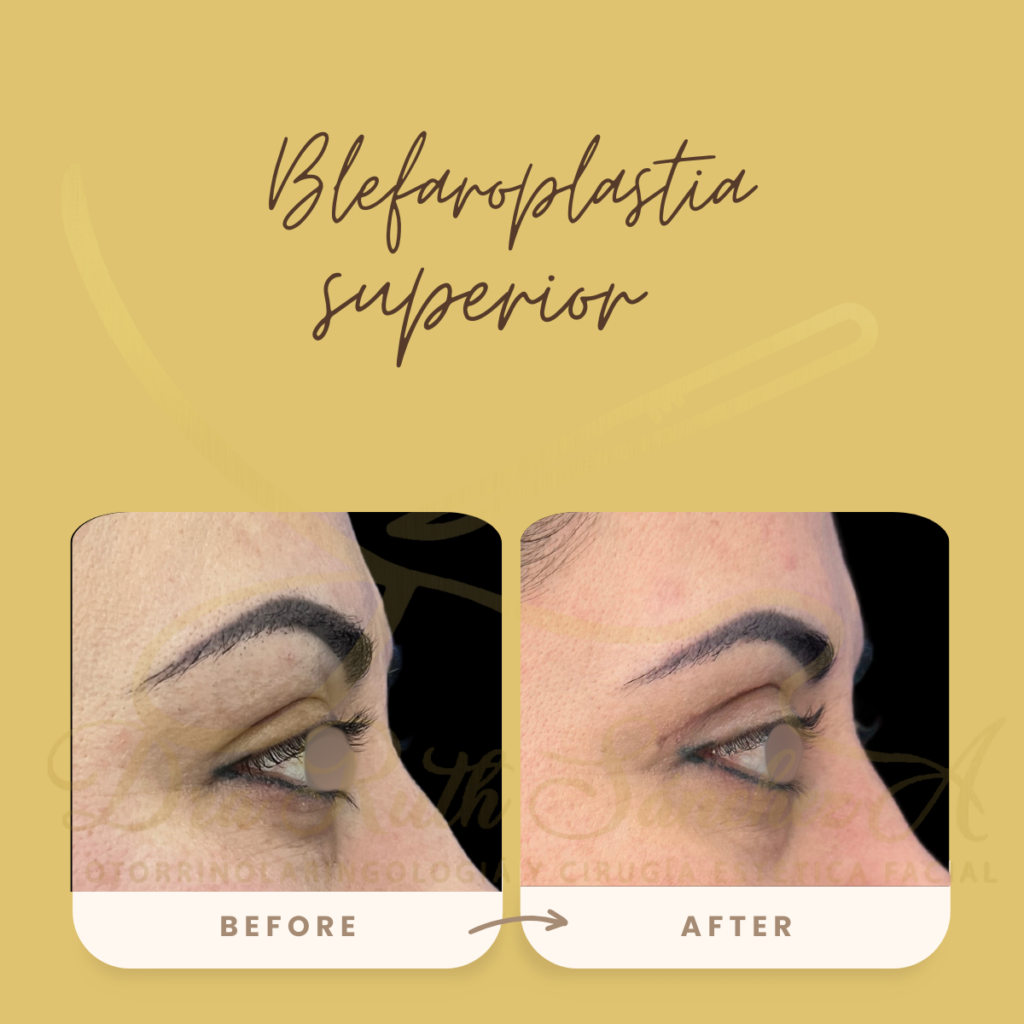 BLEFAROPLASTIA SUPERIOR E INFERIOR ​9