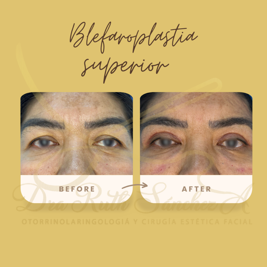 BLEFAROPLASTIA SUPERIOR E INFERIOR ​4