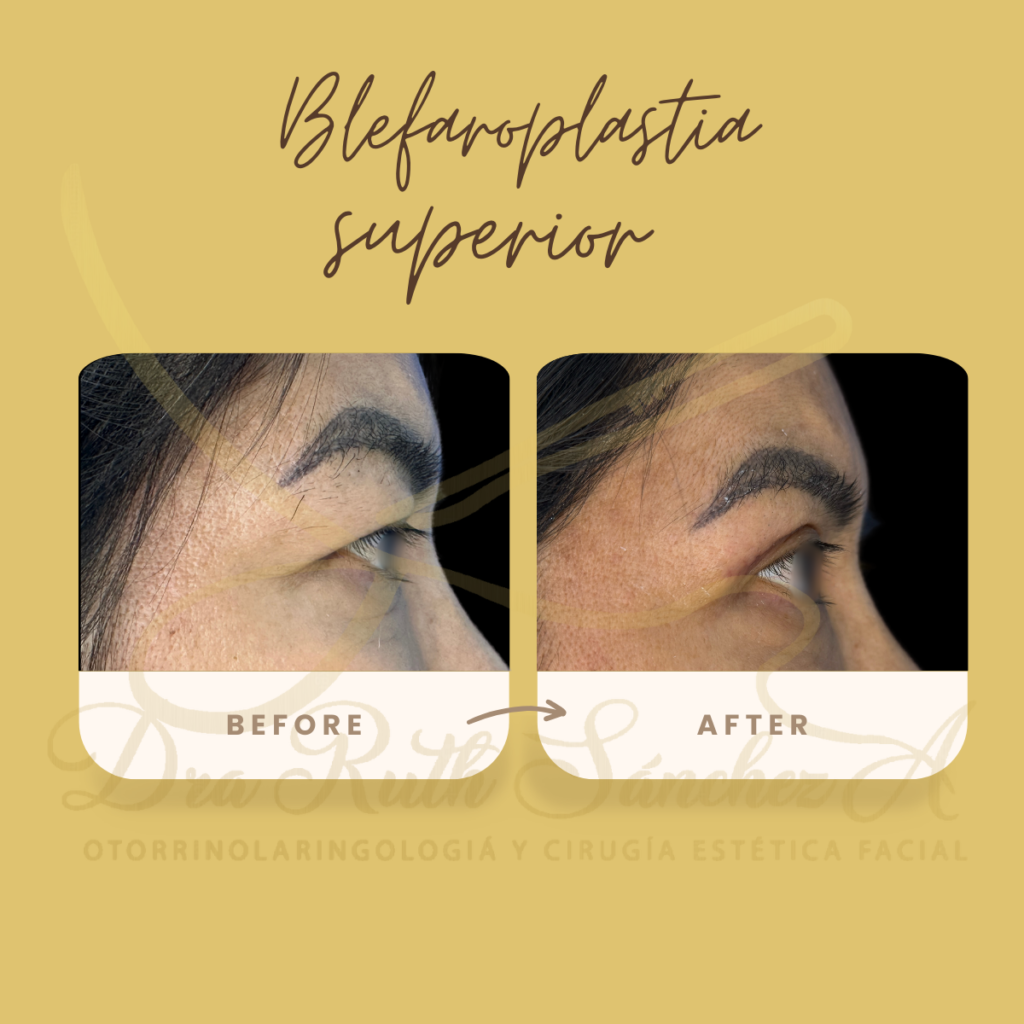 BLEFAROPLASTIA SUPERIOR E INFERIOR ​