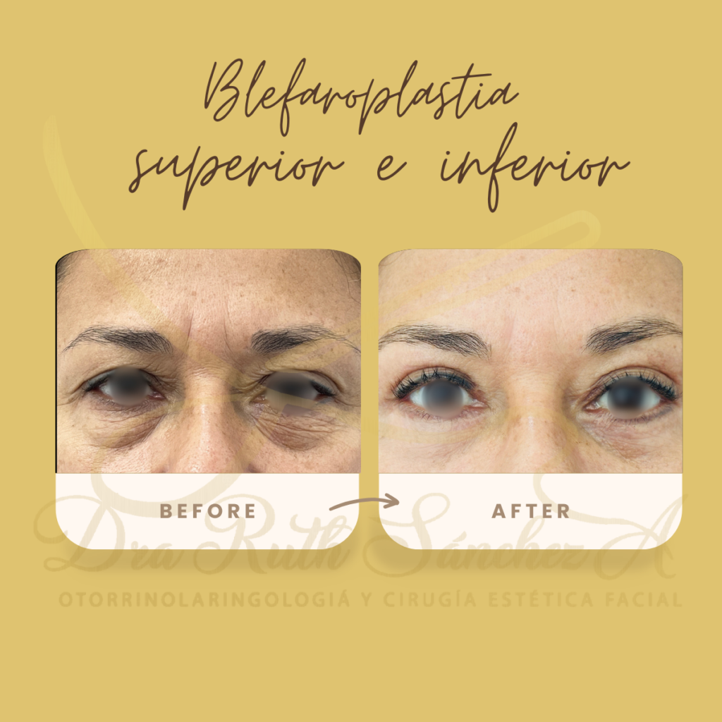 BLEFAROPLASTIA SUPERIOR E INFERIOR ​ 1