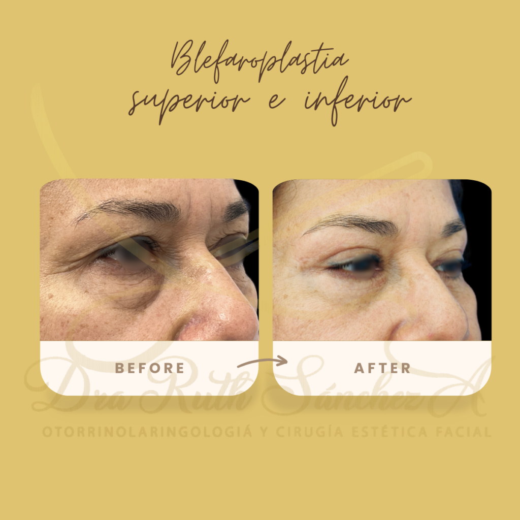 BLEFAROPLASTIA SUPERIOR E INFERIOR ​